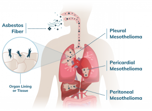 Mesothelioma