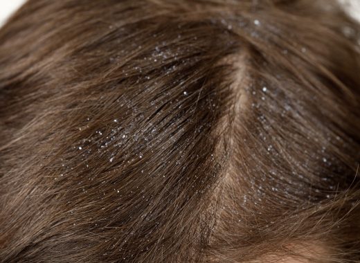 Dandruff Ruins Your Confidence
