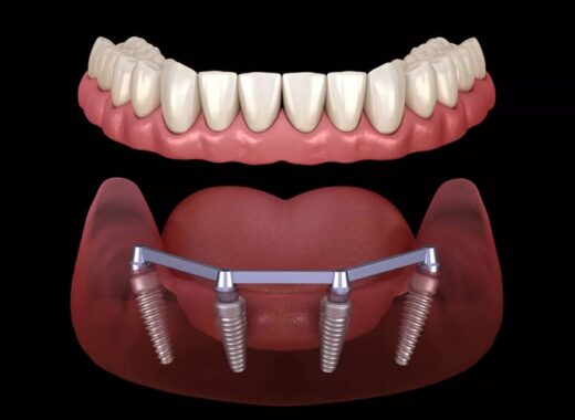 Dental Implants In The Chicago Area
