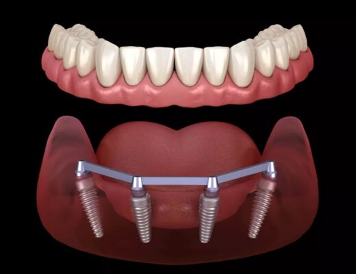 Dental Implants In The Chicago Area